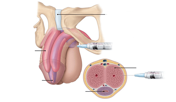 Infusion of your own fat for penis thickness